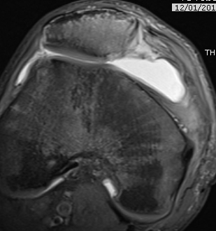 Patella Dislocation MRI MPFL Disruption Patella Side